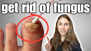 Get Rid Of Toenail Fungus With These 4 Easy Home Remedies [upl. by Steinway161]