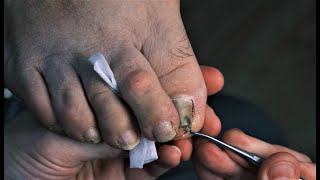 Ingrown toenail treatment Podology Podologia [upl. by Aicenad]