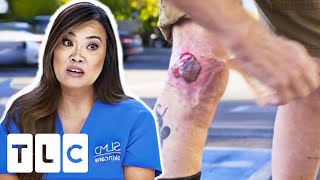 Patient Suffers From A Large Bump Thats Growing Out Of Control  Dr Pimple Popper [upl. by Rosen]