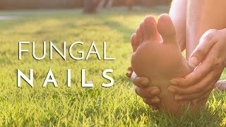 Principal Podiatrist Michael Lai Explains What Causes Fungal Toenails [upl. by Josh244]