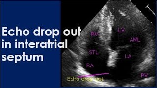 Echo drop out in interatrial septum [upl. by Persson]