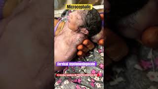 Cervical Myelomeningocele microcephaly vitaminb9 neuraltubedefects drsreedhargandikota [upl. by Elakram]