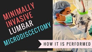 Minimally Invasive Lumbar Microdiscectomy Video  How Its Performed [upl. by Mutz]