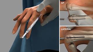 Bioretec ActivaPin™ 5th Metacarpal fracture fixation [upl. by Petronilla]