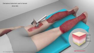 Skin Graft Procedure  Flash Fire Injury [upl. by Monroy92]