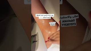 بديل الليزر من زيت السعد😭الخطاب للأكسسوارت 775301573 shorts funny music youtubeshorts art edit [upl. by Rabma]