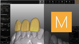 Converting eggshell pontics into anatomic pontics in ZirkonzahnModellier  ZirkonzahnSoftware [upl. by Yrtnahc]