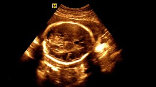 Routine antenatal ultrasound at 28 weeks gestation Ultrasonography of a 28week pregnancy [upl. by Dinsdale]