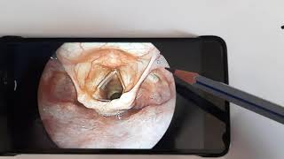 Anatomy of Laryngopharynx HypopharynxENT [upl. by Jaine]