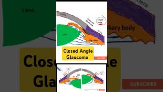 Closed Angle Glaucoma [upl. by Rehpotsirh]