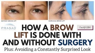 Brow Lifting with and without Surgery and Importance of Avoiding a Surprised Look [upl. by Layney]