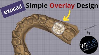 Simple Overlay Design in exocad [upl. by Filberto46]