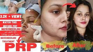 prp microneedling treatment kia hota haiPRP micro needling kese hota haifull explained in urdu [upl. by Dez]