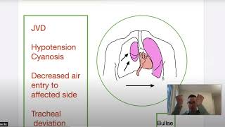 Tension Pneumothorax Pathophysiology Etiology and Treatment in the Prehospital Setting [upl. by Lativa]