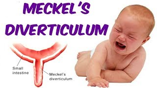 Meckels Diverticulum [upl. by Secnarfyram]