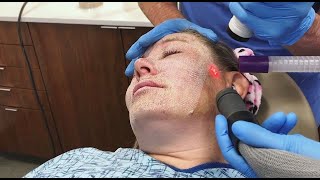 Full Face Fractional CO2 Laser Resurfacing for Wrinkles and Skin Tightening [upl. by Nwadal343]