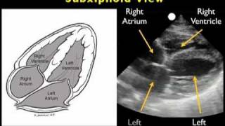 How to Echocardiography  Subxiphoid View [upl. by Ellard177]