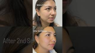 EzGel To Erase UnderEye Hollows undereyecircles facialaesthetics prf [upl. by Oleta928]