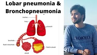 Pneumonia  Lobar pneumonia and BronchopneumoniaBy Abhishek sir [upl. by Kaule]