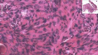 Meningioma  Histopathology [upl. by Lezned]