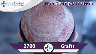 Haartransplantaion Erfahrungen  Elithairtransplant Türkei [upl. by Nnairahs]