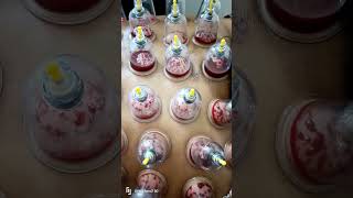 hijama hijamatherapyshorts [upl. by Benedix485]