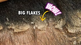 Picking Big Scalp Flakes Psoriasis Dandruff Scratching Satisfying 301 [upl. by Chang]