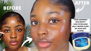 HOW VASELINE HELPED CLEAR MY ACNE AND EZCEMA FASTER  KAISERCOBY [upl. by Nanoc]