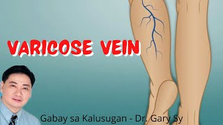 Varicose Vein  Dr Gary Sy [upl. by Rybma348]