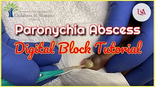 Finger Paronychia Emergency amp Digital Block Tutorial [upl. by Onurb]