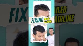 Failed Hair Transplant Correction hairtransplant hairtutorial shorts ytshorts [upl. by Emili]