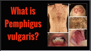 What is PEMPHIGUS VULGARIS Symptoms Causes [upl. by Pinelli]