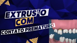 Extrusão com contato prematuro dralexguedes [upl. by Nylak472]