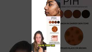 Best Serum for Acne Marks  Clear Skin with These Top Picks  Skincare SkinCareRoutine [upl. by Bathelda]