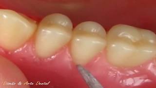 3  🔴 DEFINICIÓN DE CUELLOS 🔴 en Protesis total dental ARMONIA [upl. by Ahsahtan926]