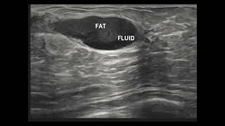 Differentiating Breast Abscess and Galactocele on Ultrasound with practical tips [upl. by Acemaj252]