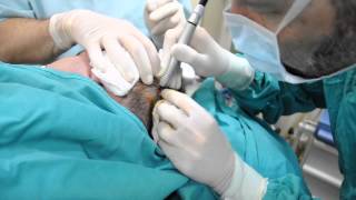 Ablatie cu laser CO2 tumoreta scalp Dr Jianu ProEstetica [upl. by Adnovoj201]