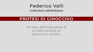 Protesi di Ginocchio 10 mesi dalloperazione di protesi parziale [upl. by Esinwahs]