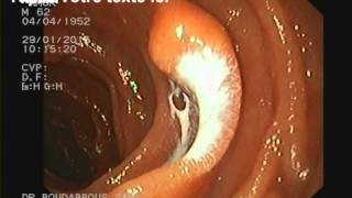 lactocele duodenal [upl. by Layne]