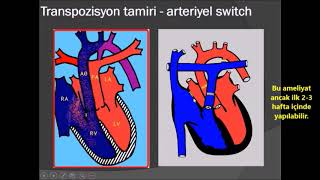 SİYANOTİK KONJENİTAL KALP HASTALIKLARI 2 [upl. by Perreault84]