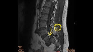 Spondylolisthesis Spine Fusion Surgery L4S1 [upl. by Nahpets186]