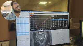 CSF Flow study Philips 3T post processing VideoPart2avnishradiology [upl. by Holey]