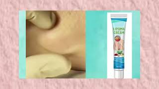 Lipoma cream reviews [upl. by Yecies]