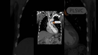 Persistent left superior vena cava SVC ct chest shoets [upl. by Olivann]