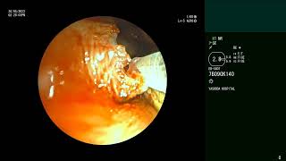 Adenoid cystic carcinoma of Trachea  Silicone Y stent  Complications Bronchoscopic management [upl. by Angelia]