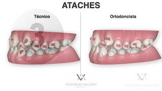 Claves para mejorar la PREDICTIBILIDAD en Compresiones Esqueléticas y Mordidas Cruzadas INVISALIGN [upl. by Eenhpad]