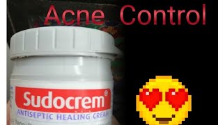 Sudocrem Acne Control [upl. by Giesecke341]