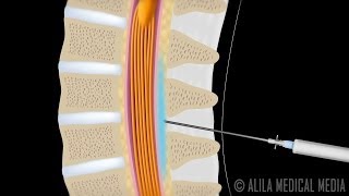 Lumbar Epidural Steroid Injection Animation [upl. by Seabrooke408]