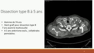 Prévention des anévrismes thoracoabdominaux après dissection aortique par stent multi couche [upl. by Katzen]