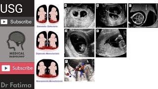 Chorionicity ampAmnionicity of twins on ultrasound By DrFatima [upl. by Nomead]